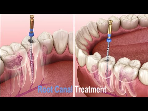What Happens During a Root Canal Procedure