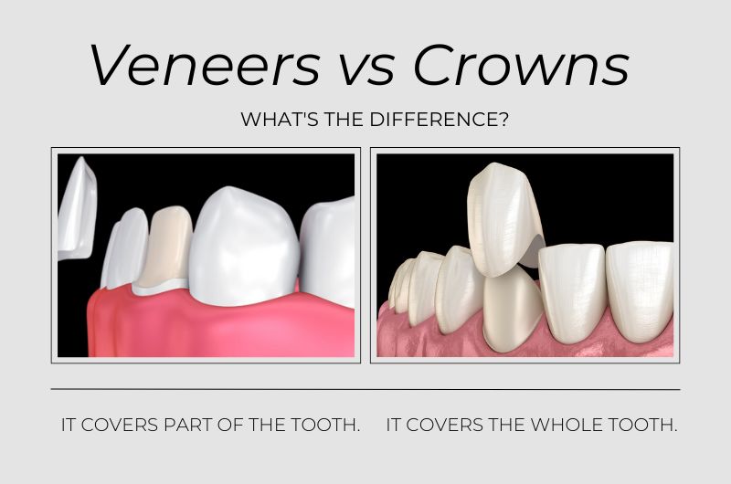 dental crown vs veneer
