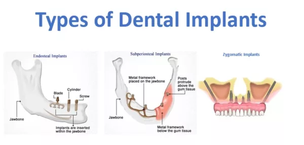 types of dental implants