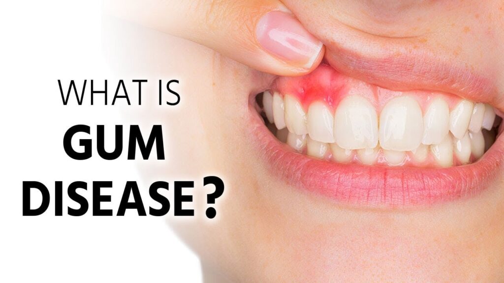 what is gum disease