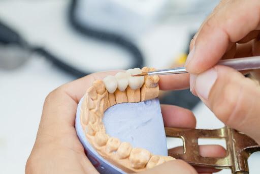 Top Reasons to Choose Smile Dental for Dental Bridge Treatment